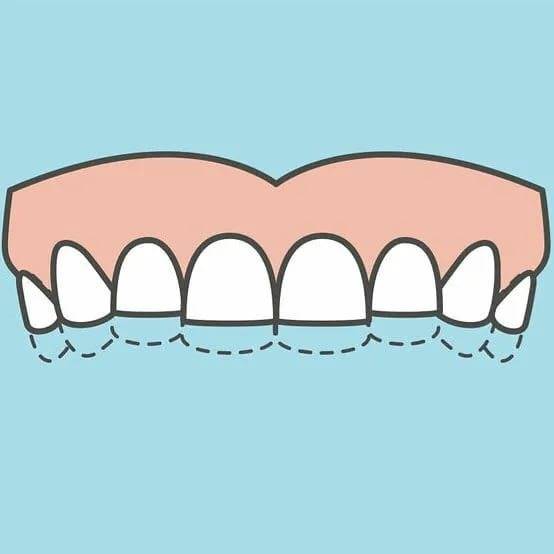 Что делать если оголяются шейки зубов, как это лечить?